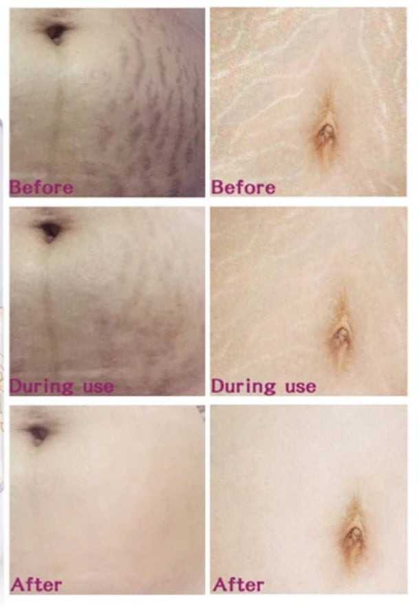 Trujuli Stretch Mark Lotion-1 fl oz